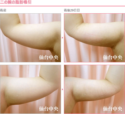 二の腕の脂肪吸引 症例写真