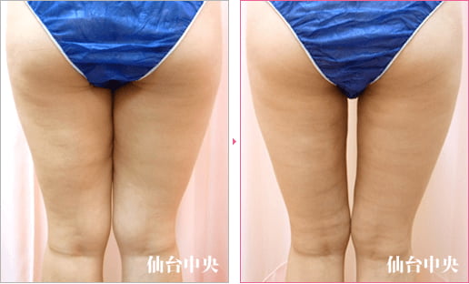 大腿内側脂肪吸引 症例写真2