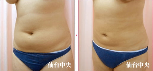 腹部脂肪吸引 症例写真3